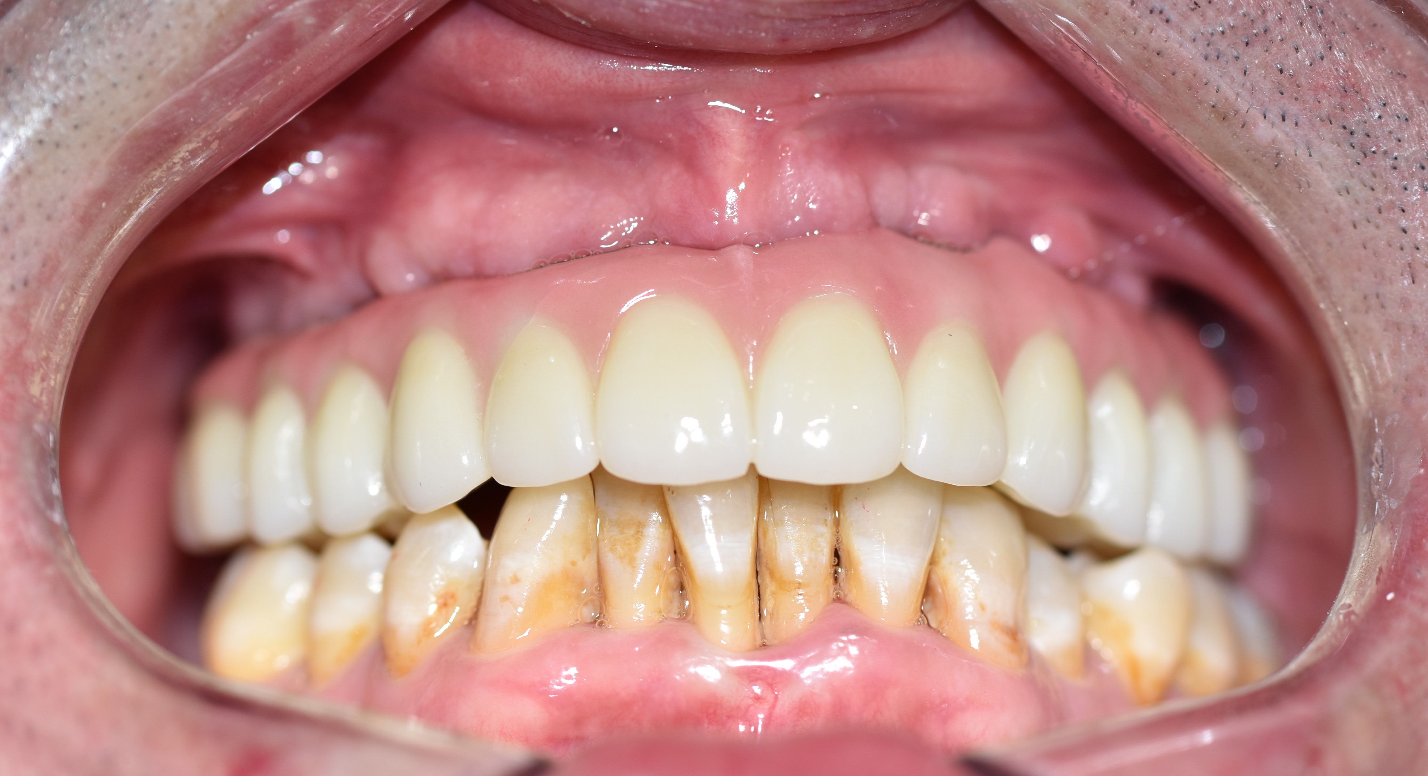 After treatment